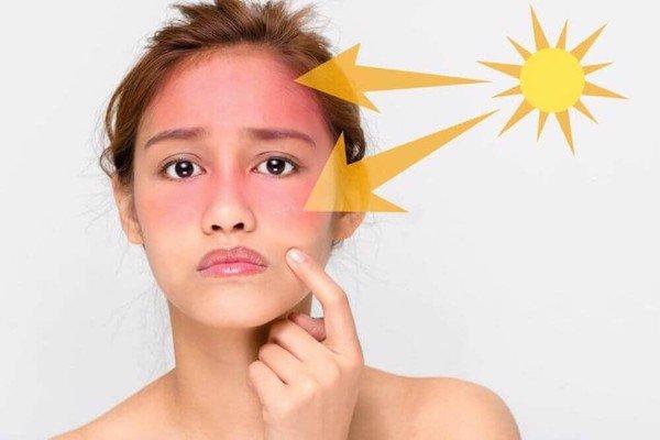 Hình ảnh minh họa một người phụ nữ bị cháy nắng vùng mặt và vai, biểu cảm nhăn nhó vì đau rát, minh họa cho việc nắng nóng kéo dài ảnh hưởng đến làn da như thế nào